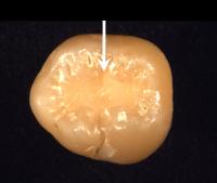 A calcium phosphate nanocomposite filling in a tooth. The nanocomposite can "smartly" release decay-fighting agents to buffer against acids produced by bacteria, and rebuild the lost tooth minerals by releasing ions into the mineral-deficient area of the tooth.