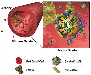 The synthetic HDL, based upon gold nanoparticle scaffolds, binds cholesterol and can potentially eat away at cholesterol-containing plaques. (Credit: Weston Daniel, David Giljohann and Michael Wiester, Mirkin Research Group)