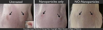 Abscesses in mice that received placebo, nanoparticle alone or
nanoparticle with nitric oxide for 4 days after MRSA abscess formation.
The inset in the untreated group shows what the contents of the MRSA
abscess look like at this time.