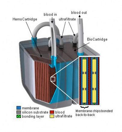 A model of the implantable bioartificial kidney shows the two-stage system. Thousands of nanoscale filters remove toxins from the blood, while a BioCartridge of renal tubule cells mimics the metabolic and water-balance roles of the human kidney.