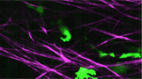 Cancer cells (green) spreading through tissue surrounding a tumour