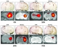 These images show the retention of doxorubicin and ND-DOX in brain tissue, with light microscopic images (upper rows) and fluorescence images detecting fluorescence generated from doxorubicin (lower rows).

The images show the distribution of unmodified doxorubicin and ND-DOX after convection-enhanced delivery (CED) at 6, 16, 24 and 72 hours.