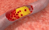 Artery-clogging bad cholesterol could one day be fought with a new type of good cholesterol made in the lab.
Credit: iStock/Thinkstock