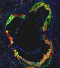 Mount Sinai's novel HDL nanoparticle (red), loaded with a statin drug, specifically targets and locally treats inflammatory macrophage cells (green) hiding inside high-risk plaque within blood vessels.

Credit: Mount Sinai