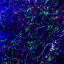 Tumor tissue in the lungSource: Sabine van Rijt, CPC/iLBD, Helmholtz Zentrum Mnchen