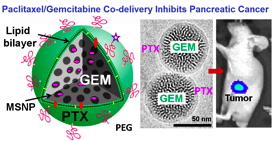 Pancreatic cancer treatment image