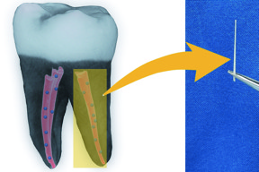 American Chemical Society/Dong-Keun Lee
A 3-D image of a tooth filled with nanodiamond-enhanced gutta percha, and an individual gutta percha point.