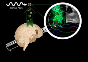 In brains affected by Alzheimer's, researchers identify chemically reduced iron species, with mineral forms including a magnetic iron oxide which they hypothesize are produced during formation of amyloid protein plaques
CREDIT
University of Warwick/Dr Joanna Collingwood
