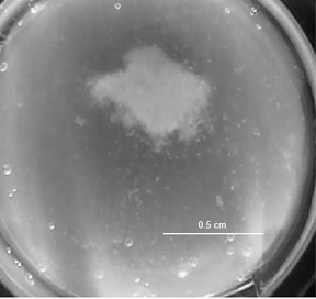 This image shows a breast macrotumor of invasive ductal carcinoma type embedded in gel. (Image provided)