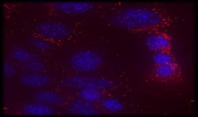 Bubbly extracellular vesicles (in red), carrying a combination of therapeutic drugs and genes, target breast cancer cells (in blue) in mice. Courtesy photo.